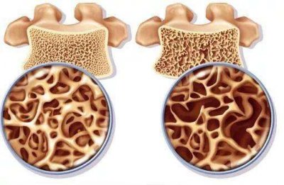 ​骨质疏松症状 总有一天，你会矮5厘米？带你了解骨质疏松常见症状