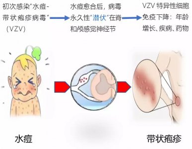 ​带状疱疹治疗方法 带状疱疹正确治疗方法