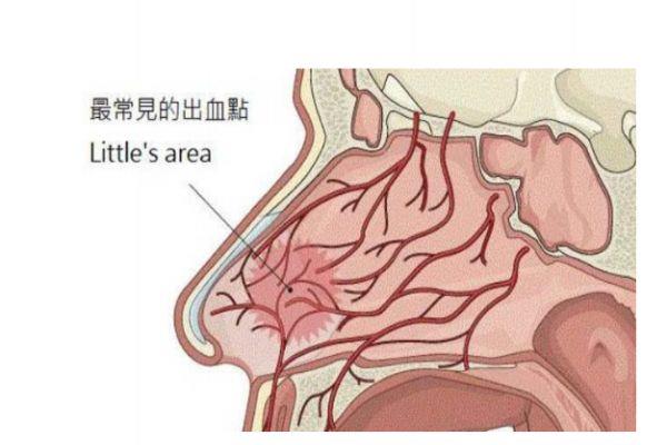 经常流鼻血是怎么回事 经常流鼻血怎么办